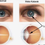 Penyakit Katarak Dapat Menyebabkan Kebutaan Jika Tak Di Obati