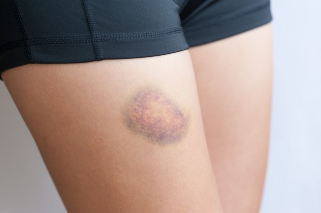 Penyakit Leukemia Ada Beberapa Jenis Yang Harus Di Ketahui